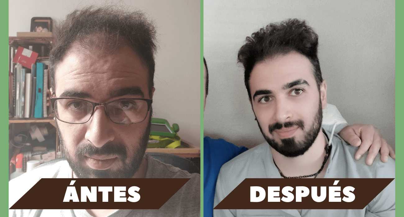 8 Años Usando Minoxidil | Mi experiencia